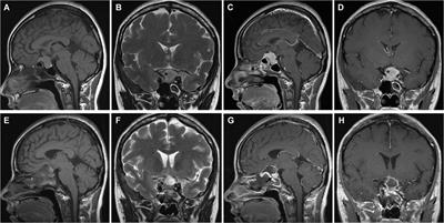 Surgical management of tuberculum sellae meningioma: Transcranial approach or endoscopic endonasal approach?